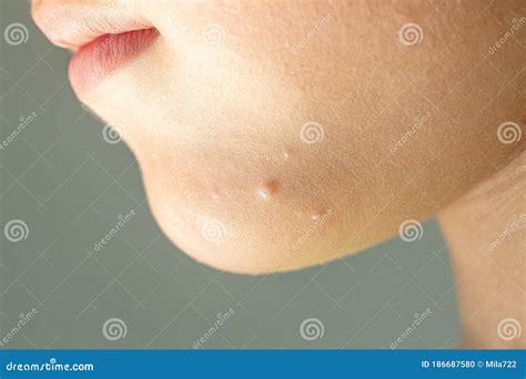 Molluscum Contagiosum Skin Lesions Also Called Water Warts Royalty-Free ...