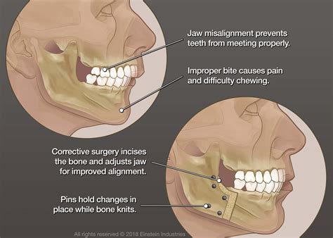 Corrective Jaw Surgery | Midwest Oral Surgery