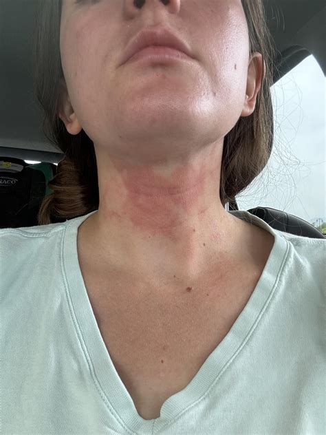Mysterious recurring neck rashes : r/Autoimmune