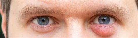Types of Eyelid Cysts | Tunbridge Wells Eye Centre