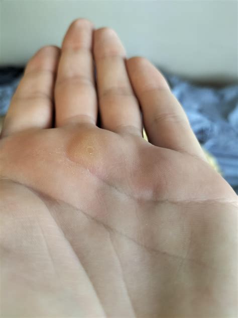 Had these lumps on my palms between my middle and ring finger for about 4 and a half years : r ...