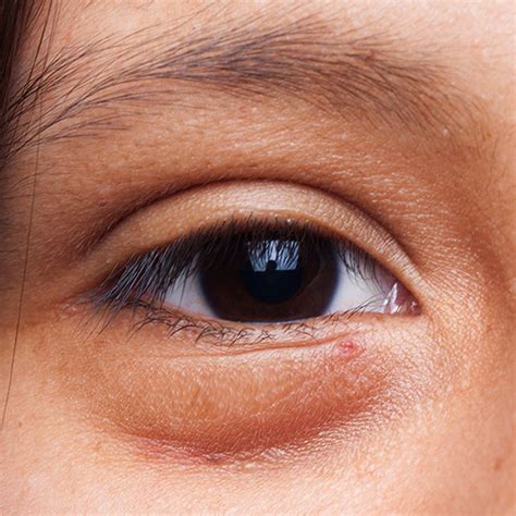 Swollen Eyelid | Causes, Treatments, Remedies