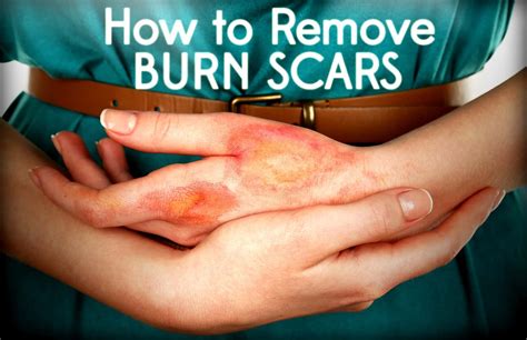 Scar Management In Burns at Claire Grissom blog