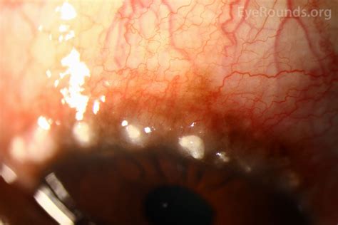 Atlas Entry - Limbal vernal keratoconjunctivitis (VKC)