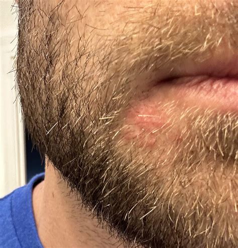 Rash on side of chin/mouth? Can’t get it to go away! : r/Dermatology