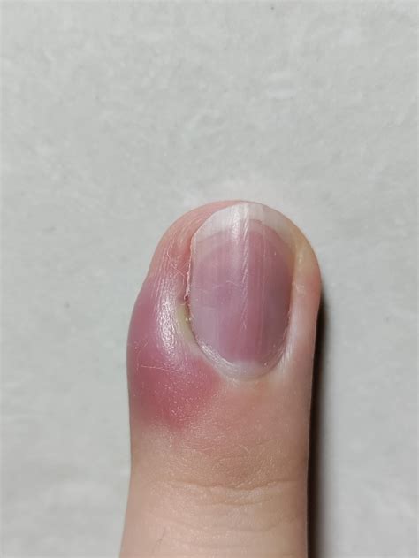Infection in finger : r/medical