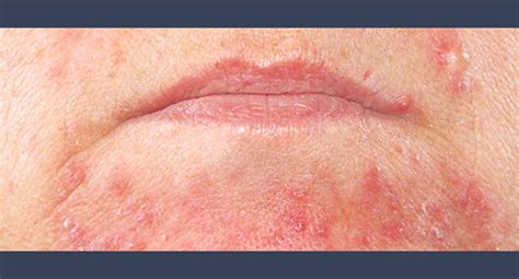 Skin Rash #1: Perioral Dermatitis