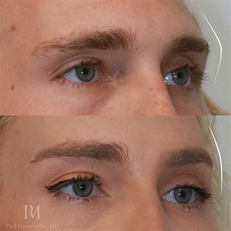 Orbital Rim Contouring for Facial Feminization - Paul Mittermiller, MD