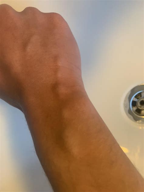 Why Is There A Lump On My Vein at Wayne Tisdale blog