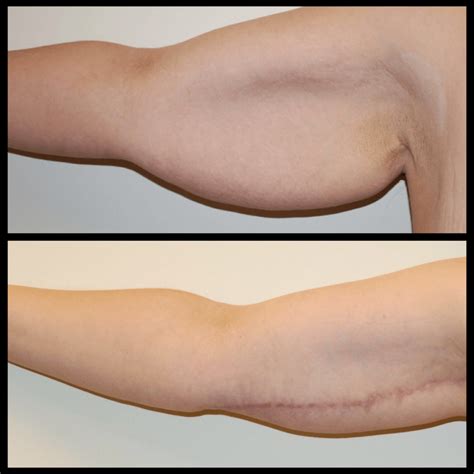 Arm Lift in Mountain View, Los Gatos, & Morgan Hill, CA | SF Bay Area Plastic Surgery