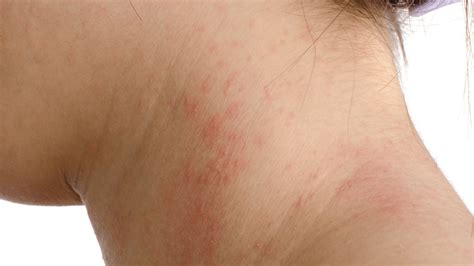 7 Types of Eczema: Causes, Symptoms, & Treatments | Gladskin