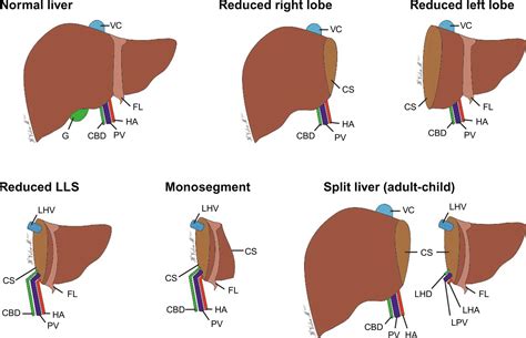 What Is Different Between Pediatric and Adult Liver Transplantation ...
