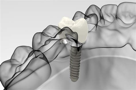 Top Dental Implant Restoration in Coral Gables & Miami - South Gables Dental