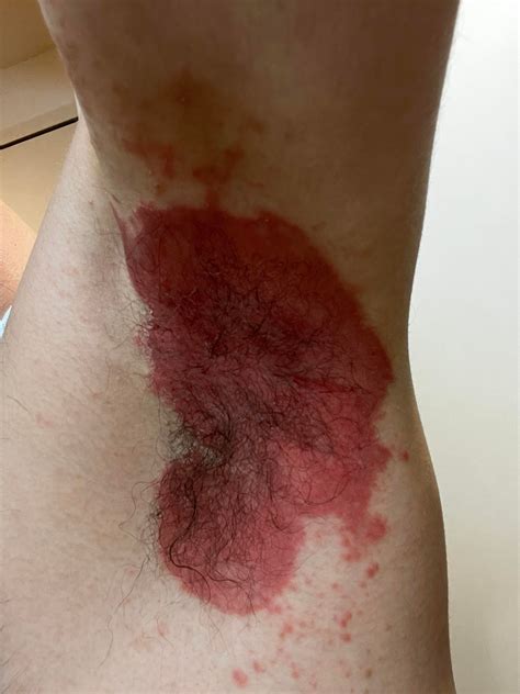 Candida Infection Under Armpit