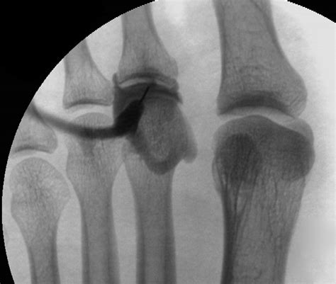 MR Arthrography of the Second and Third Metatarsophalangeal Joints for ...