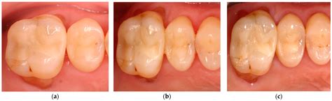 Flowable Composite Class 2 Restorations at Gloria Moreno blog