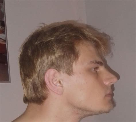 Short-face-syndrome or weak Chin? : r/jawsurgery