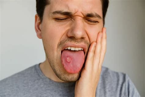 Llagas en la lengua | Causas, tratamiento y remedios eficaces