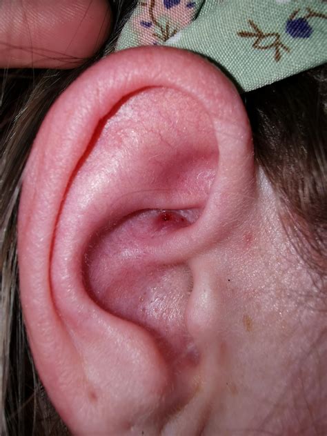 Aftermath of my huge ear pimple. : r/popping