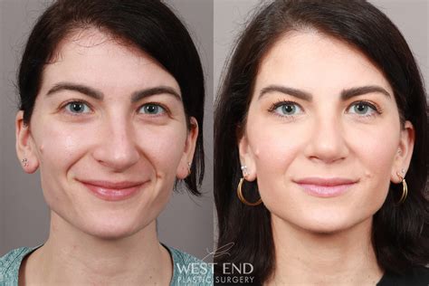 Septoplasty Only Before And After