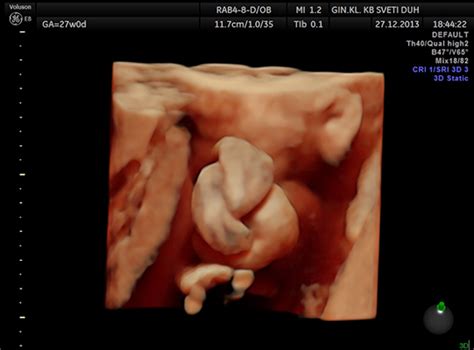 Do we sometimes see too much? Prenatal diagnosis of a true umbilical ...