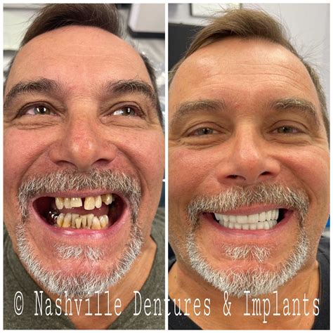 How Much Does A Set Of Dentures Cost At Affordable Dentures at Hamish ...