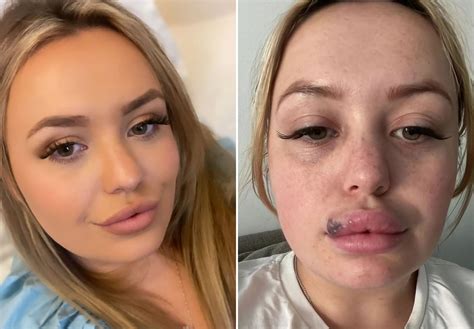 Plastic Surgery Duck Face