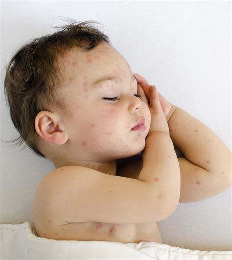 Impetigo In Babies: Causes, Symptoms, Diagnosis And Treatment