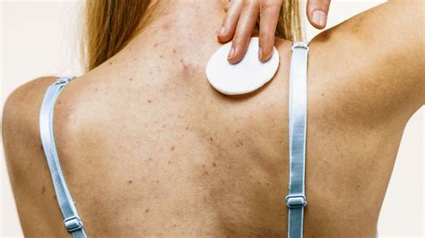 Bacne Facial - How A Back Facial Can Remove Blackheads