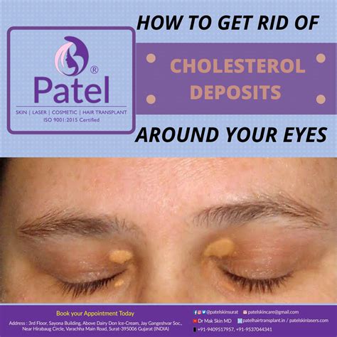 Xanthelasma is a sharply demarcated yellowish deposit of cholesterol underneath the skin. It ...