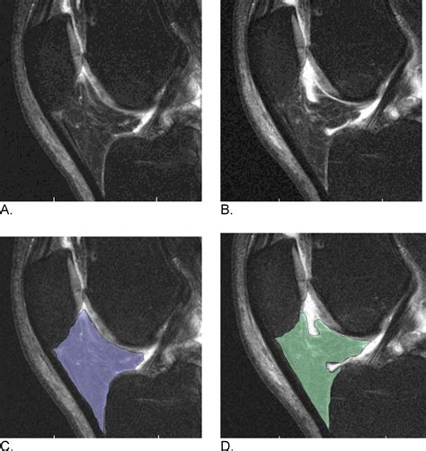 Magnetic resonance imaging of Hoffa's fat pad and relevance for ...