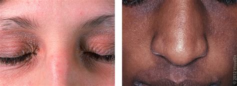 Facial Eczema