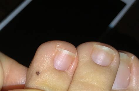 A suspicious mole on my middle toe : r/Melanoma
