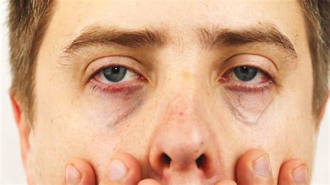 Causes of Eyelid Twitches - Oakes Opticians