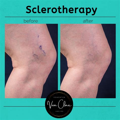 Sclerotherapy for Varicose & Spider Vein Treatment - EDMONTON VEIN CLINIC