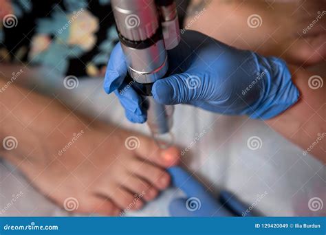 Podology Treatment. Podiatrist Treating Toenail Fungus. Doctor Removes Calluses, Corns and ...