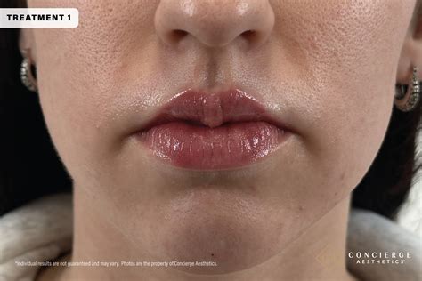 M-Shaped Lip Filler Transformation | Natural, Hydrated Results ...