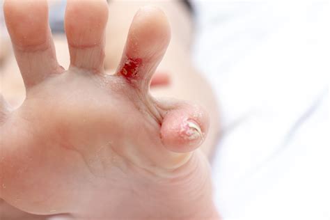 Itchy Bumps On Bottom Of Feet
