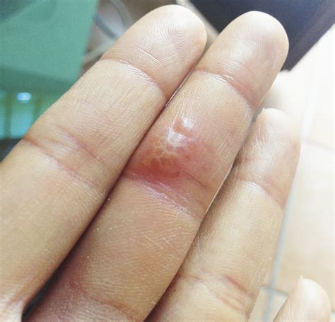 What Is Whitlow Finger at Lincoln Fenner blog