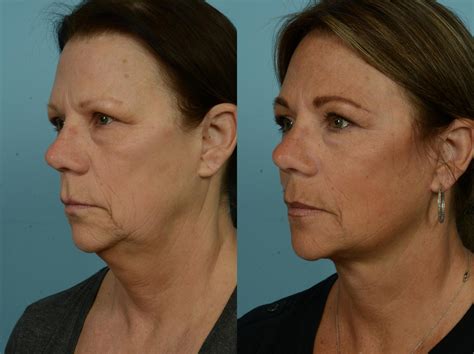 Deep Plane Facelift by Dr. Mustoe Before and After Pictures Case 973 | Chicago, IL | TLKM ...
