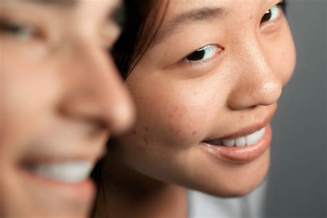 Why Do Blackheads Form? Understanding the Root Causes - Skin To Heart ...