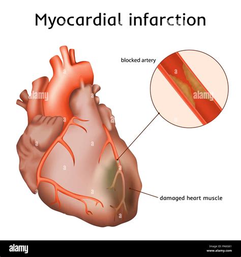 Anatomy Of Myocardial Infarction Type 2 Myocardial Infarction (MI)