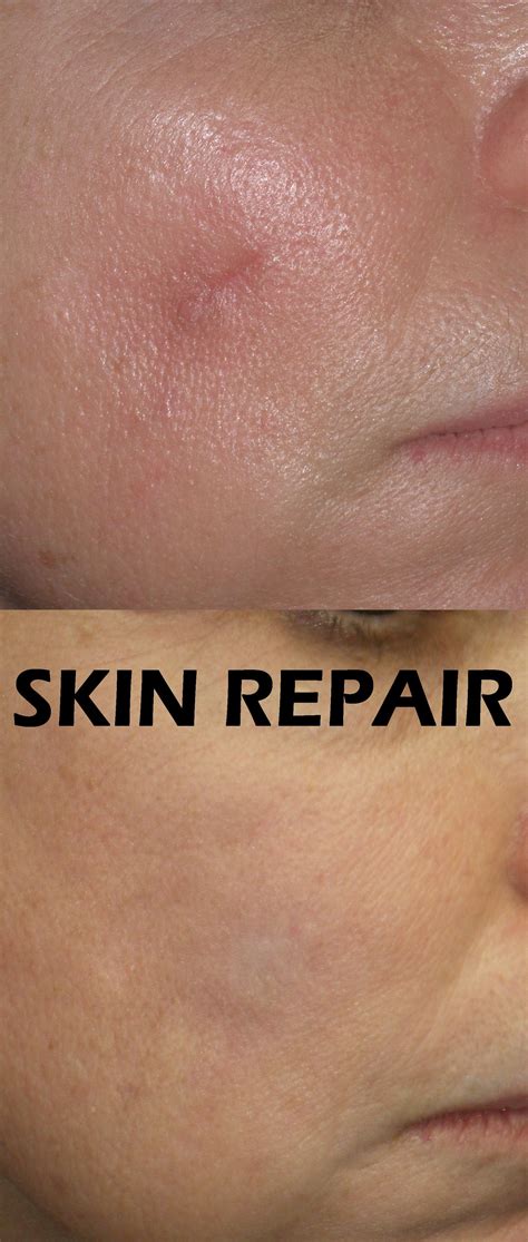 Hyaluronic Acid Help Acne Scars at Kai Hartung blog