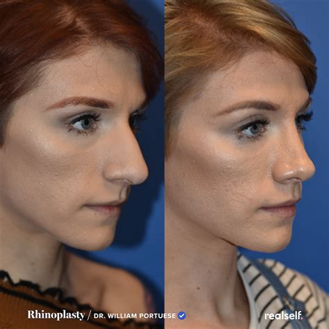 Rhinoplasty: The Ultimate Guide to a Nose Job - RealSelf | Nose job, Rhinoplasty before and ...