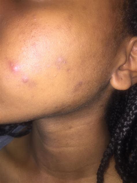 [Acne] 14F -What can I do to get rid of cystic acne and acne scars? : r ...