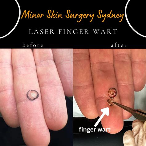 Warts On Fingers Removal Wart Removal: Techniques And Prevention