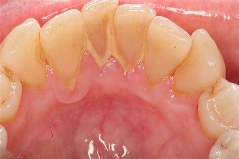 Calculus Teeth Removal At Home