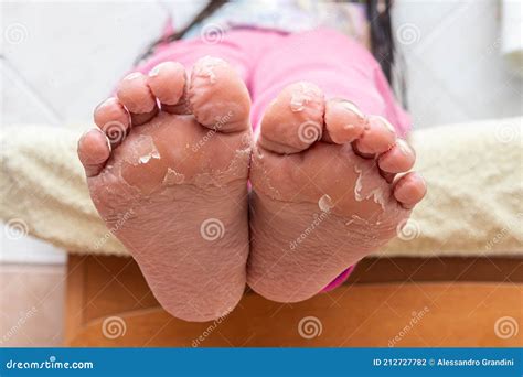 Feet of Little Girl with the Skin Peeling Off at the Flaps Stock Photo ...