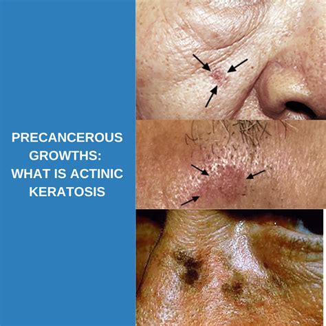 Precancerous Growths: What is Actinic Keratosis? - Savannah River Dermatology
