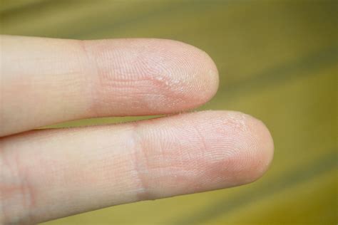 How To Remove Epoxy From Skin? - SCOSZD